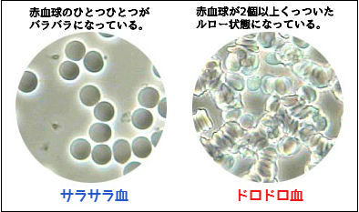 サラサラ血とドロドロ血